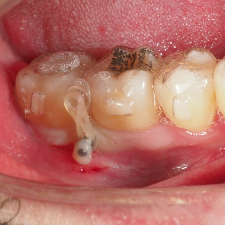 microimplantes ortodoncia